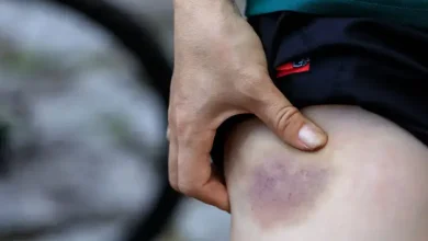 چه بیماری هایی باعث کبودی بدن میشود