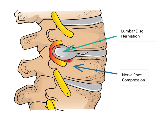 فتق دیسک بین مهره_ای کمر (Lumbar Disc Herniation - LDH) به عنوان یکی از دلایل رایج کمردرد و دردهای انتشاری شناخته می_شود. - تصویر 2