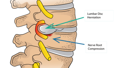 فتق دیسک بین مهره_ای کمر (Lumbar Disc Herniation - LDH) به عنوان یکی از دلایل رایج کمردرد و دردهای انتشاری شناخته می_شود. - تصویر 2