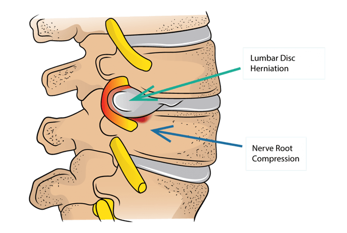 فتق دیسک بین مهره_ای کمر (Lumbar Disc Herniation - LDH) به عنوان یکی از دلایل رایج کمردرد و دردهای انتشاری شناخته می_شود. - تصویر 2
