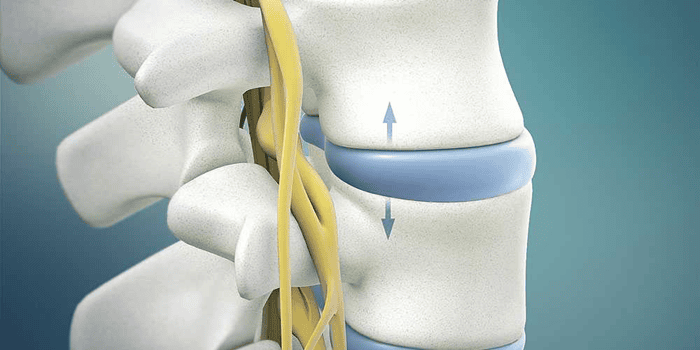 عمل دیسک کمر با لیزر